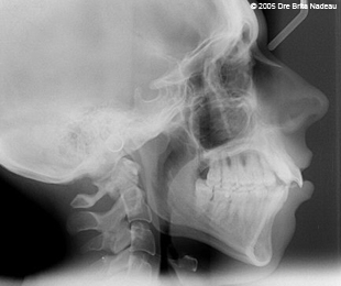 Marie-Hélène Cyr - Cephalometric X-ray before the orthodontic treatments (November 24, 2005)